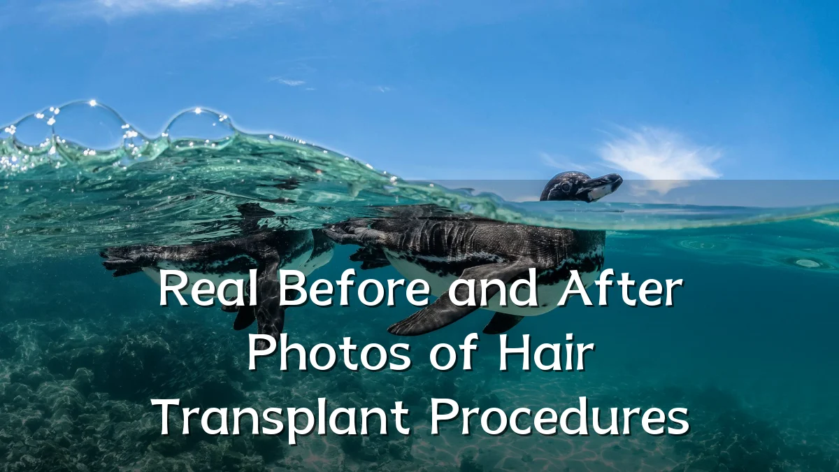 Real Before and After Photos of Hair Transplant Procedures